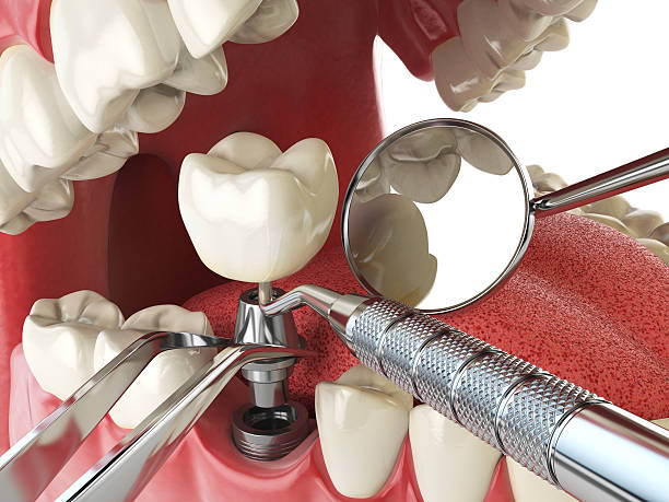 Best Dentist for Tooth Abscess  in Benton, IL